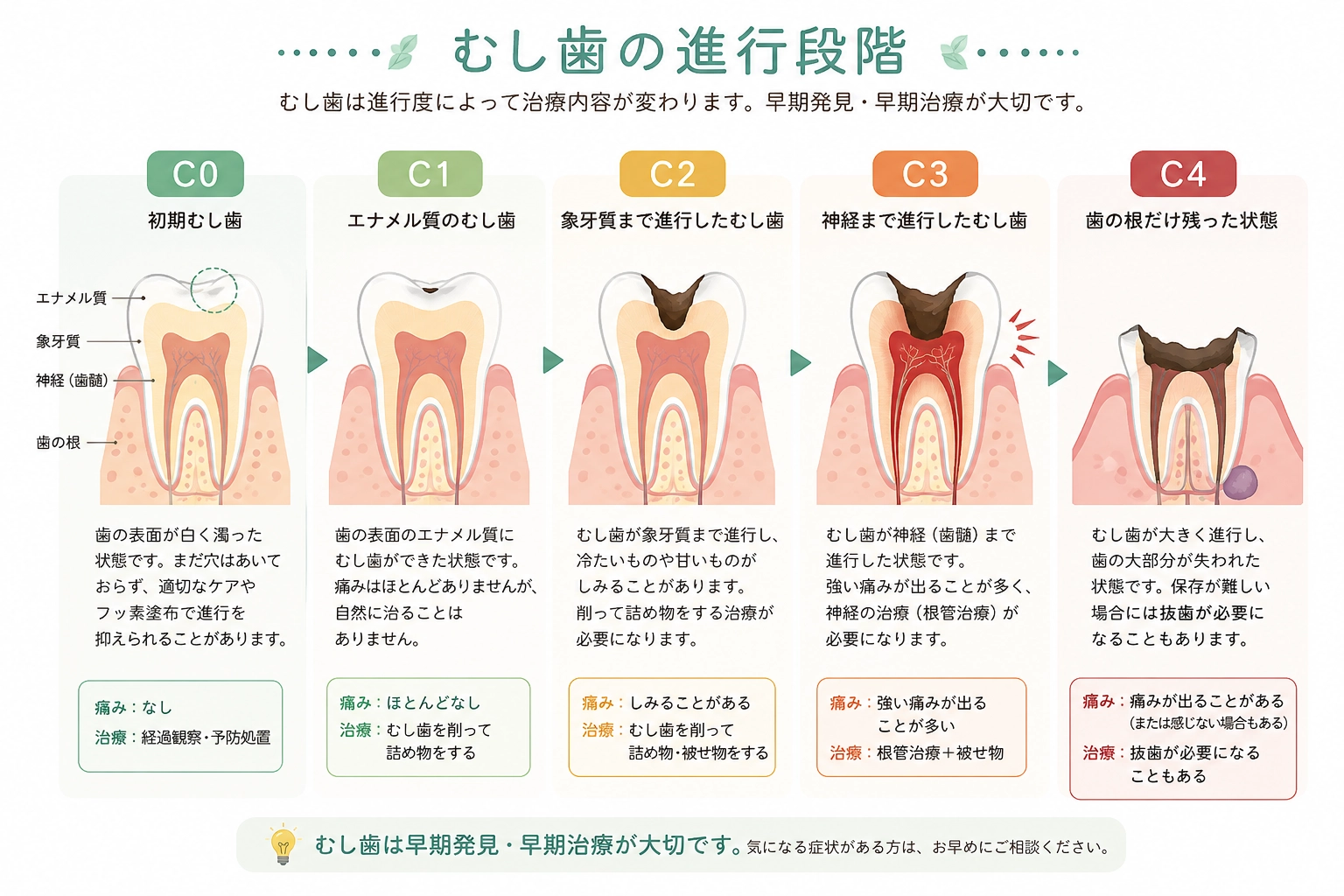 むし歯がC0からC4へ進行する段階を示したイラスト